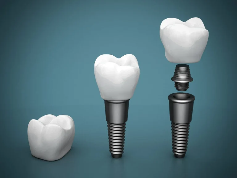 Transform Your Smile: The Benefits of Dental Implants